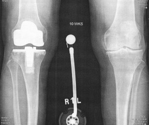Xray of full knee replacement